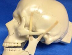 EMG Guided Lateral Pterygoid Muscle Botox-A Injection for Chronic TMJ