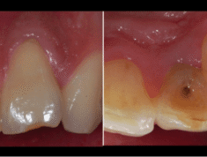 Endodontic Management of an Infected Immature Tooth with Spontaneous Root Closure and Type II Dens Invaginatus
